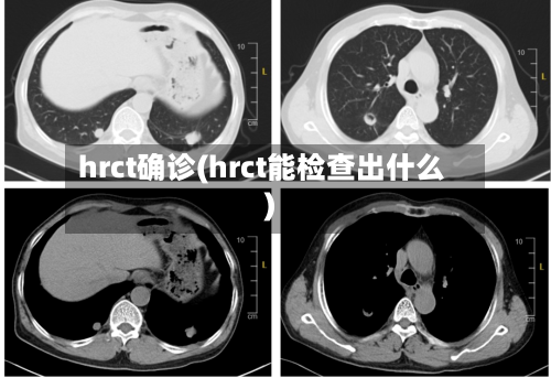 hrct确诊(hrct能检查出什么)-第2张图片